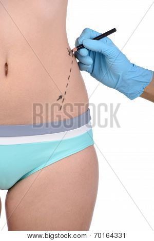 Anaplasty