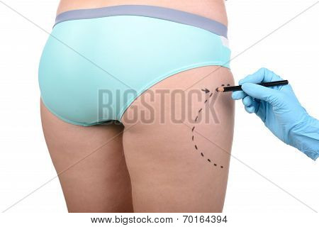 Anaplasty