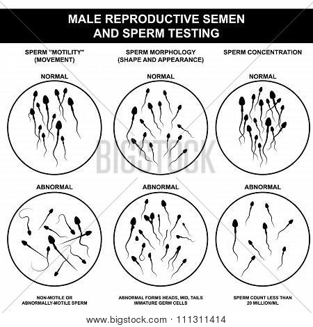 normal and abnormal sperm