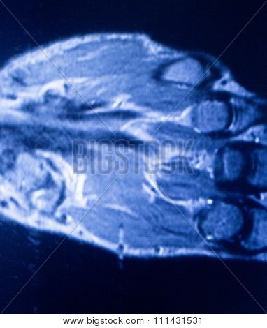 Mri Magnetic Resonance Imaging Hand Finger Scan