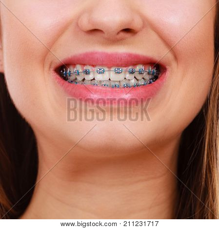 Dentist and orthodontist concept. Woman smile showing her white teeth with blue braces