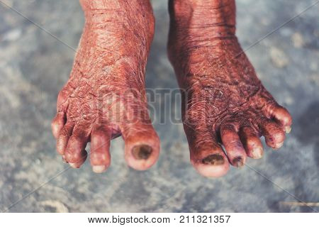 Withered Feet Of Old Woman, Withered Tan Skin, Healthy And Long Live Concept