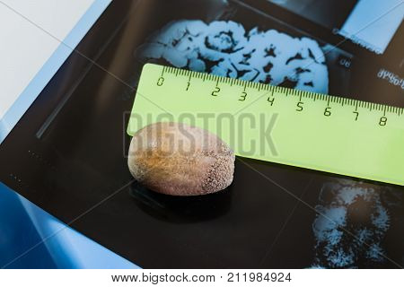 A large stone from the gallbladder on the background of the x-ray of internal organs and line formed when the disease of calculous cholecystitis, gallstone disease