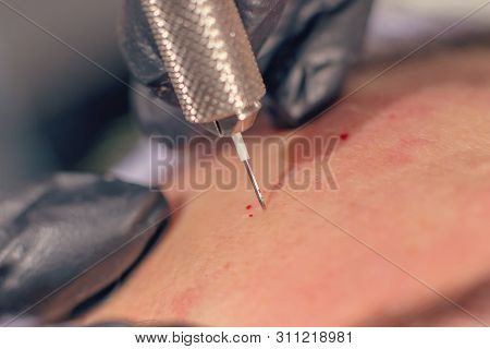 Needle Wrinkle Treatment. Needle Mesotherapy Single Needle Clopse Up.