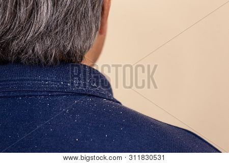 Close-up View Of A Man Who Has A Lot Of Dandruff From His Hair On His Shirt And Shoulders