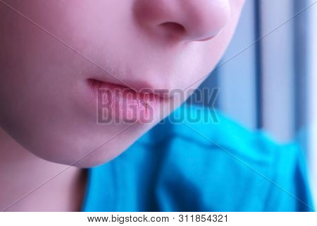 Little Cut On Boys Lip. Child Boy Licks By Tongue His Cracked Lips, Mouth Closeup. Process Of Dehydr