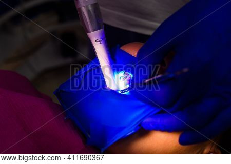 Ultraviolet Light In Dentistry, Treatment Of Upper Masticatory Teeth.