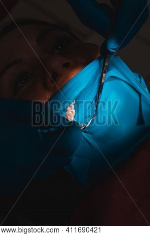 Dental Procedure, Treatment Of The Upper Masticatory Tooth, Modern Dental Treatment With A Rubber Da
