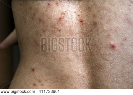A Young Girl With Acne, With Red Spots And Black Dots On Her Back.problem Skin.