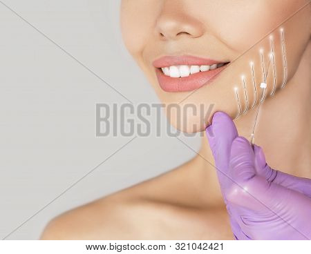 Holographic Mesothreads On The Female Face Contour. Facelift Procedure Using Mesothreads. Anti-aging