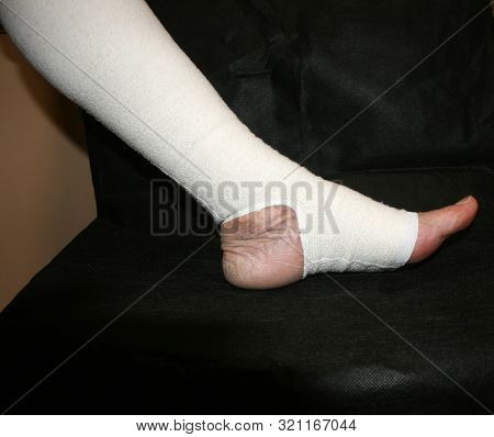 Leg. Varicose, Veins. Phlebeurysm. Thrombophlebitis. Elastic Bandage.