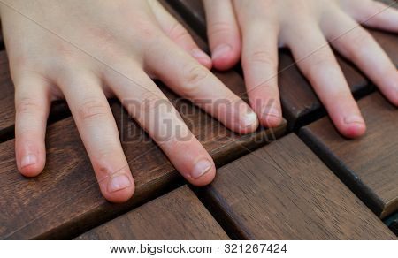 Bitten Fingernails - Bitten Fingers. Close Up Of Hands With Bitten Finger And Fingernails