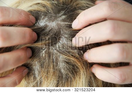 Dandruff Seborrhea Problem Of Scalp And Hair Treatment Of Peeling From Allergies Or Lichen