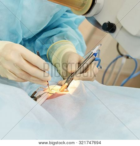 Ophthalmology Laser Microscope Operation. Doctor In Clinic. Patient Eye Treatment. Myopia And Catara