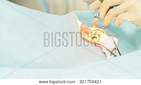 Ophthalmology Laser Microscope Operation. Doctor In Clinic. Patient Eye Treatment. Myopia And Catara