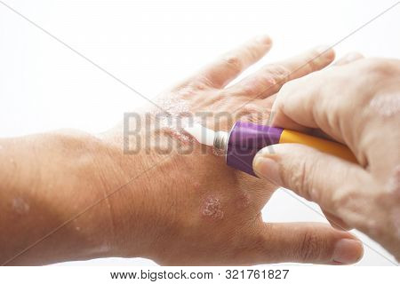 Patient Squeezes Out Of Aluminum Tubes Ointment With Medicinal Substance On Finger. Photo Of Use Of 