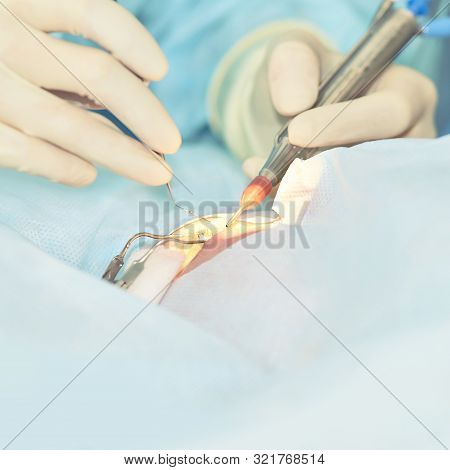 Ophthalmology Laser Microscope Operation. Doctor In Clinic. Patient Eye Treatment. Myopia And Catara