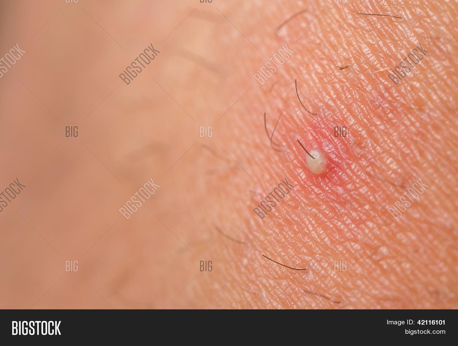 Closeup Ingrown Hair Image Photo Free Trial Bigstock