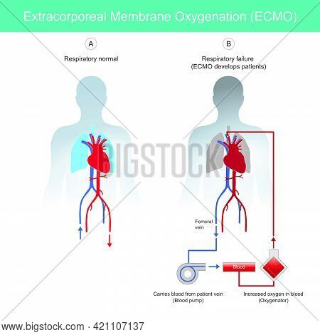 Extracorporeal Membrane Oxygenation. Diagram For Explain Rescue Patients Respiratory Failure By Usin