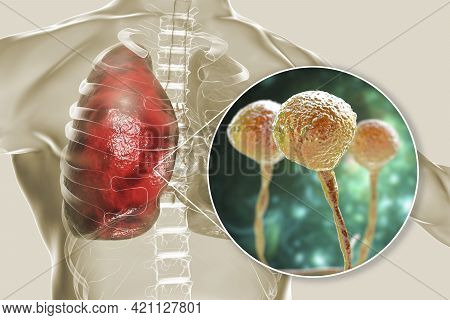 Lung Mucormycosis, A Lung Disease Caused By Fungi Mucor, Also Known As Black Fungus, With Close-up V