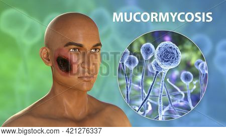 Cutaneous Mucormycosis, A Disease Caused By Fungi Mucor, Also Known As Black Fungus, 3d Illustration