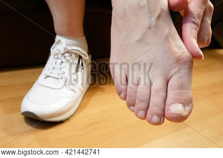 Woman's Hand Massaging Her Bunion Toes In Bare Feet To Relieve Pain. Woman Leg In White Sneakers. Wo
