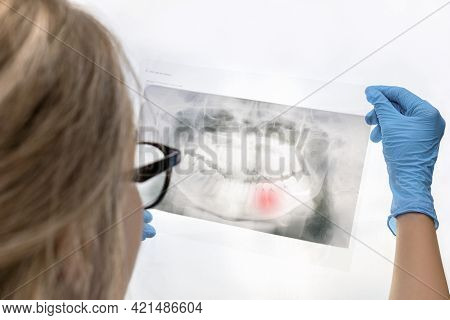 Woman Dentist Holds In Her Hands And Analyzes An X-ray Scan Of The Patients Teeth With Red Marking O