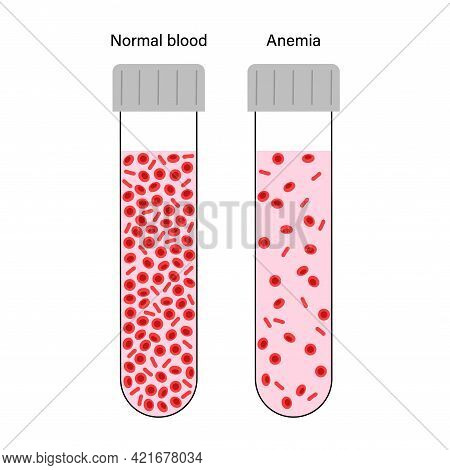Normal Blood And Specimen With Anemia Disease. Human Blood Cells Structure. Thrombocytes, Leukocytes