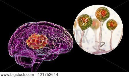 Brain Mucormycosis, A Brain Lesion Caused By Fungi Mucor, Also Known As Black Fungus, With Close-up
