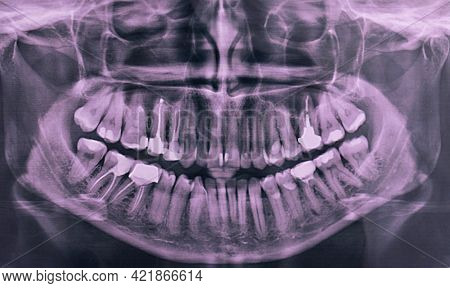 X-ray Of The Oral Cavity With Teeth. Panoramic Dental X-ray. Orthopantomogram.