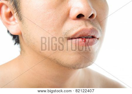 Mouth Injury Bleeding