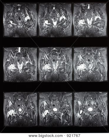 Hip Mri sekvence Stir