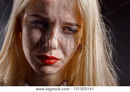 blond girl with pimply skin crying on black background