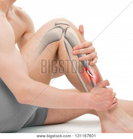 Spiral Fracture Of The Tibia - Leg Fracture 3D Illustration