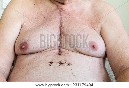 Scar From Open Heart Surgery Of Coronary Artery Disease, Where The Sternum Was Cut In Two, And The R