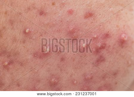Closeup Skin Problems, Nodular Cystic Acne Skin