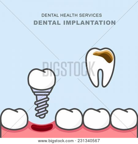 Dental Implant Instead Of Carious Tooth - Teeth Prosthetics