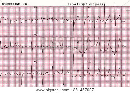 Patient's Heart Wave Chart, Which Is A Tool To Help Physicians Analyze Data In Hospitals.ekg Report 