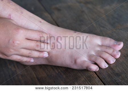 Wound Leg, Diabetic Foot Syndrome.