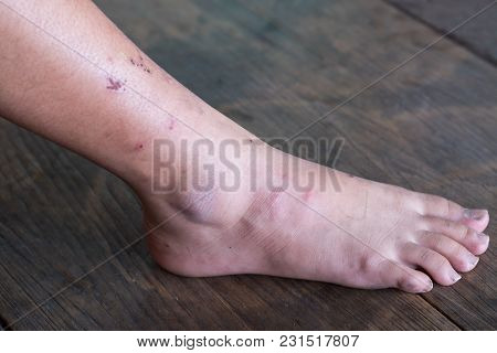 Wound Leg, Diabetic Foot Syndrome.