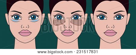 Patch Under Eyes Of Women. Girl With Mask From Swelling Of Eyebags. Vector Illustration