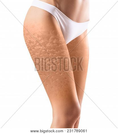 Female Buttocks With Orange Peel Texture. Isolated On White Background.