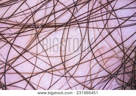 Enlarged Image Of A Human Hairy Skin With A Dermatoscope With A Millimeter Scale.