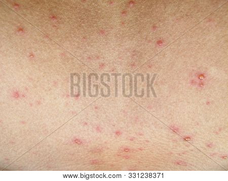 Human Skin With Chicken Pox Disease, Varicella Virus On Young Boy Body, Bubble Rash Texture