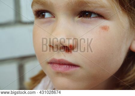 Portrait Girl With An Abrasion Under Her Eye. Child Abuse. Wounds And Abrasions