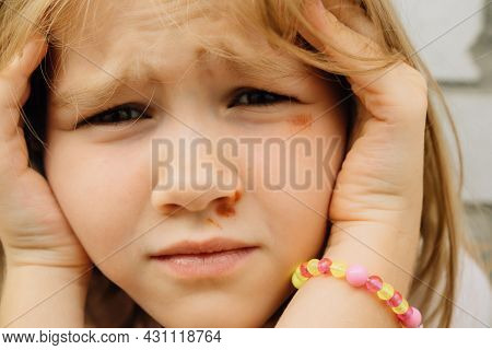 Portrait Girl With An Abrasion Under Her Eye. Child Abuse. Wounds And Abrasions