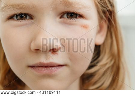 Portrait Girl With An Abrasion Under Her Eye. Child Abuse. Wounds And Abrasions