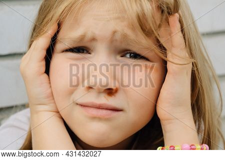 Portrait Girl With An Abrasion Under Her Eye. Child Abuse. Wounds And Abrasions