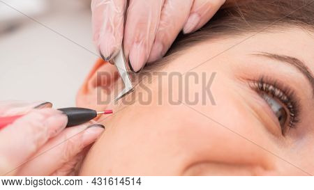 Woman On Electro-epilation Of The Face. Hardware Permanent Removal Of Unwanted Hair In The Salon