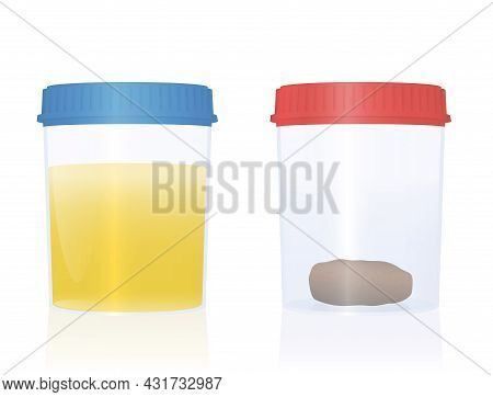 Urine And Fecal Sample In Specimen Cups With Blue And Red Cap For Urological Analysis And Medical Ex